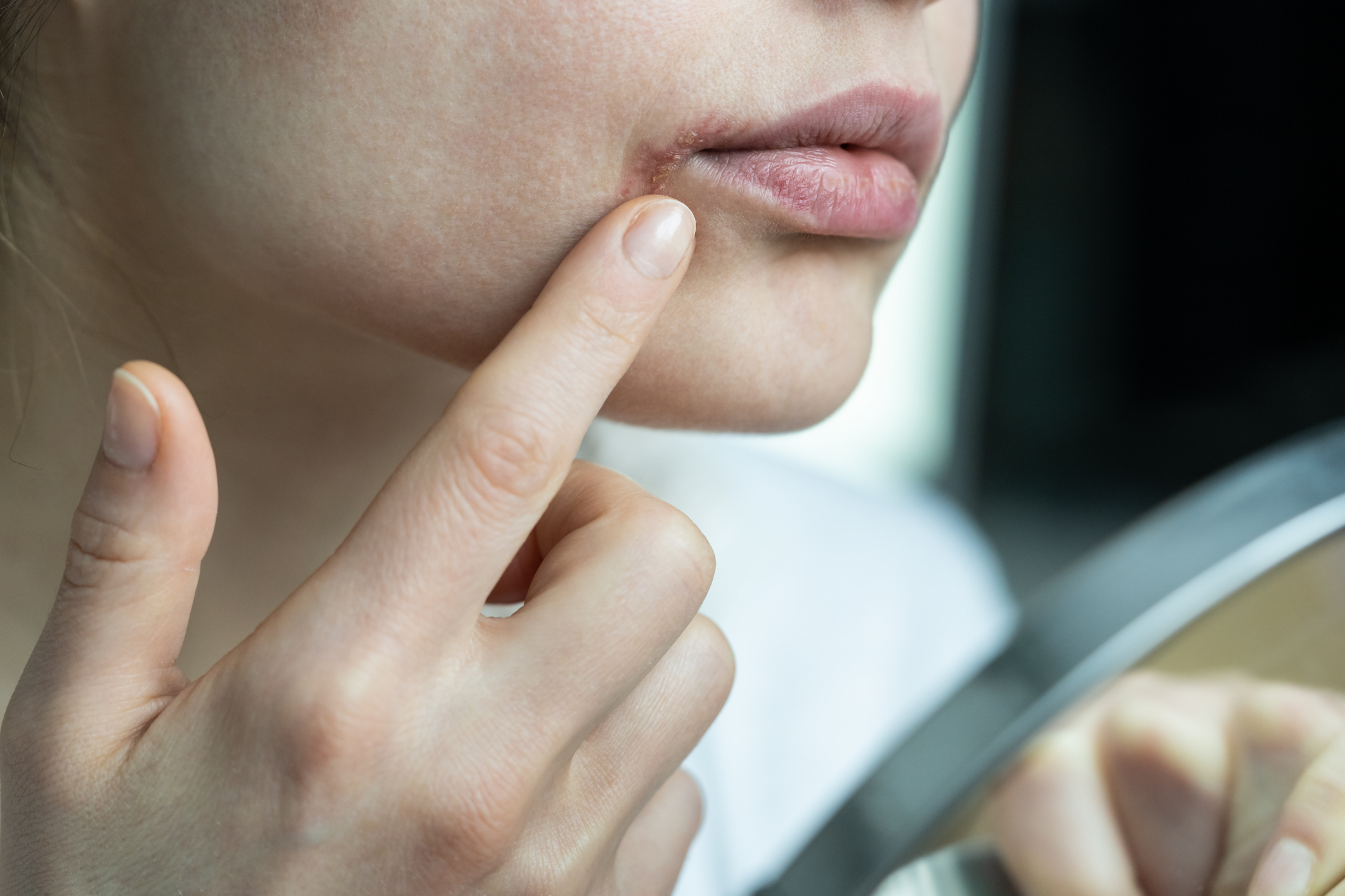 Pimple On Your Lip? Here's How To Treat It Without Popping
